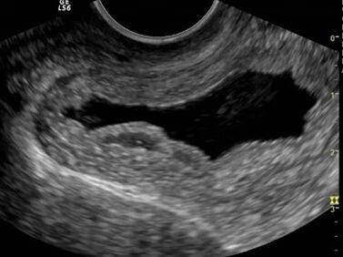 Ultrasound revealed chronic cystitis