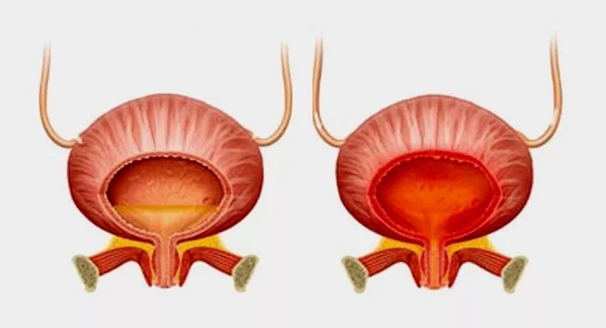 Normal bladder (left) and inflamed bladder with cystitis (right)
